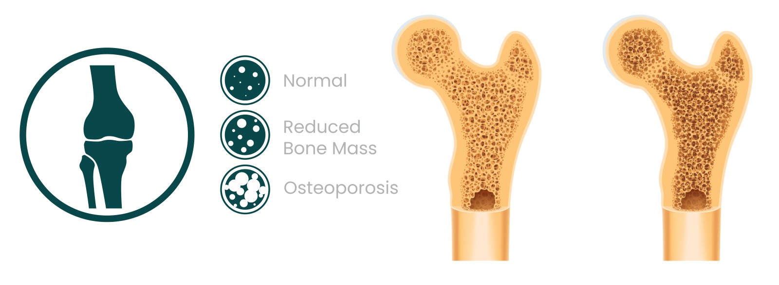 остеопороз